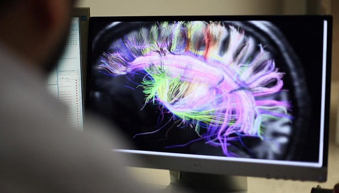 Bilim insanları, kronik ağrının beyindeki haritasını çıkarmayı başardı.Kaliforniya Üniversitesi araştırmacıları, dört gönüllünün beynine elektrotlar yerleştirdi