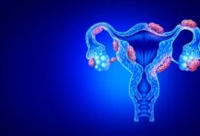 Endometriozis