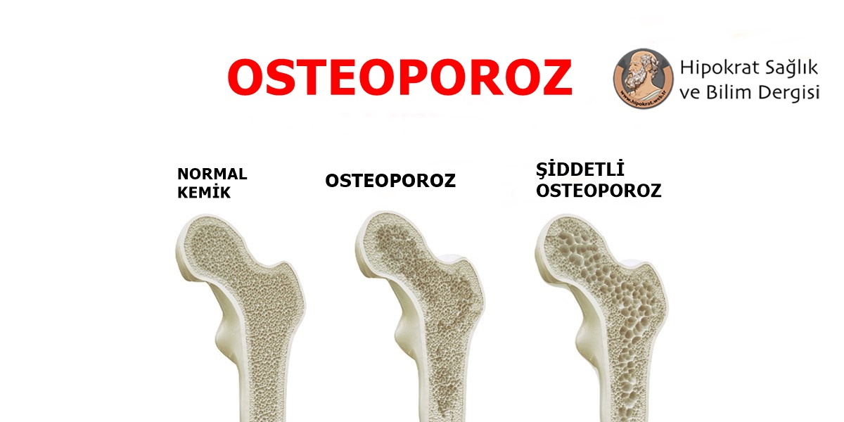 Osteoporoz Nedenleri
