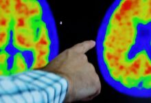 Alzheimer tedavisinde yeni aktif maddeler: Lecanemab ve Donanemab