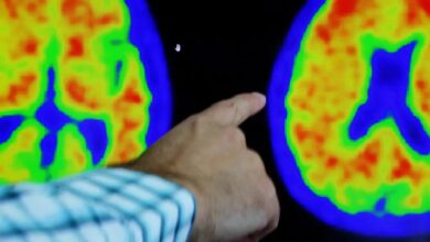 Alzheimer tedavisinde yeni aktif maddeler: Lecanemab ve Donanemab