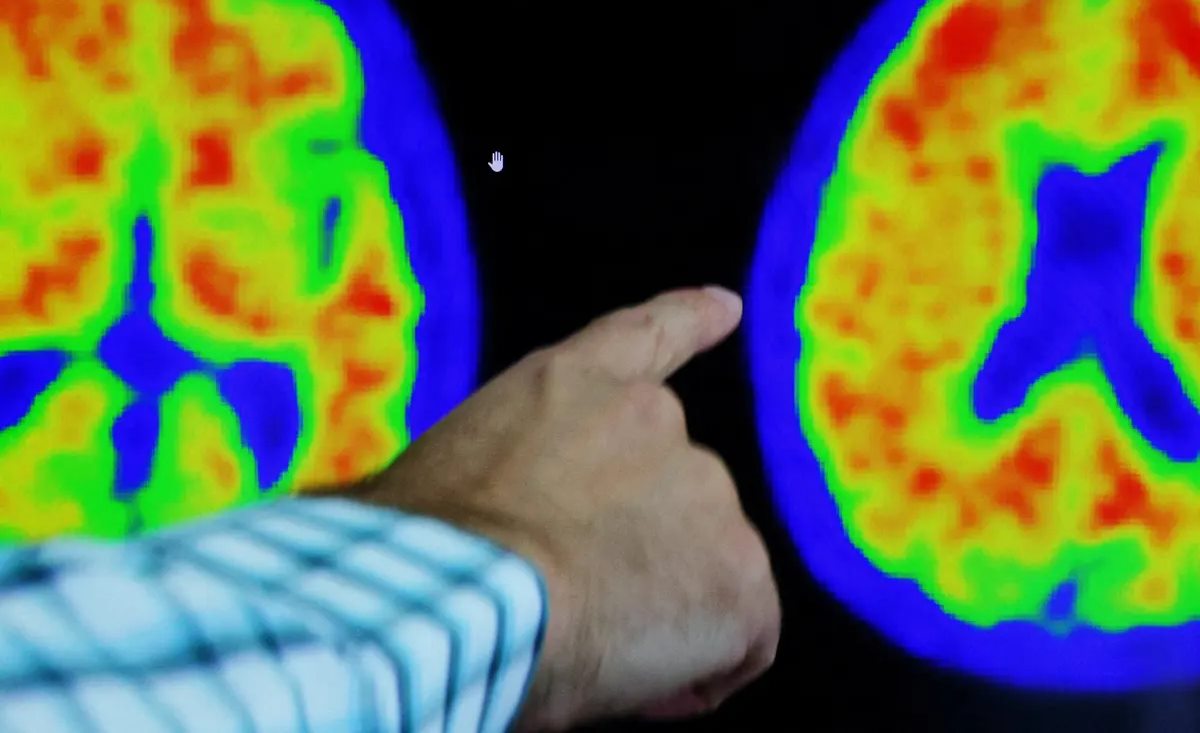 Alzheimer tedavisinde yeni aktif maddeler: Lecanemab ve Donanemab