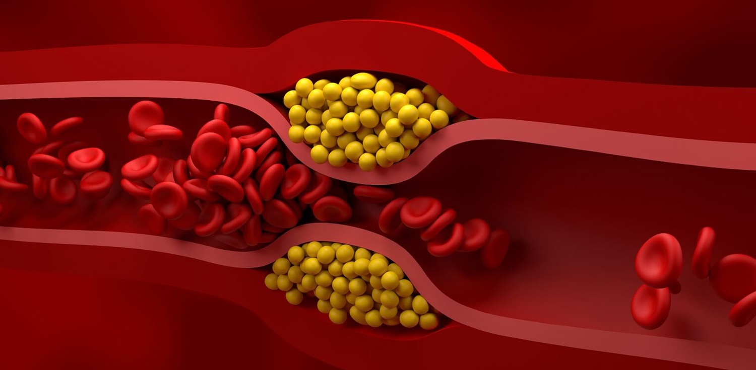 LDL Kolesterol Nedir?