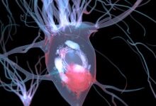 Lewy Cisimcikli Demans Nedir?