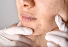 Vücudumuz kimi zaman ağrılarla çağrısında bulunur. Cilt kanserinde de bazı küçük belirtiler önem taşıyabiliyor.