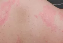 Serum Hastalığı Nedir? SSLR ile Farkı Ne?