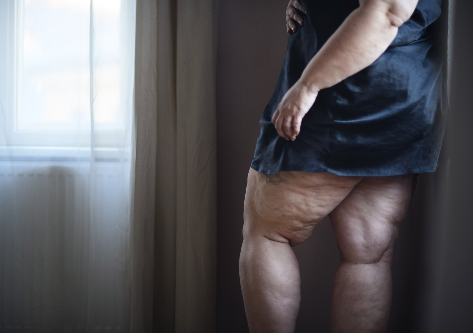 lipodem
