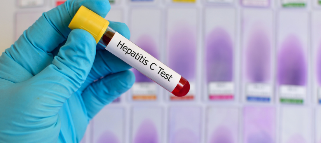 hepatit c