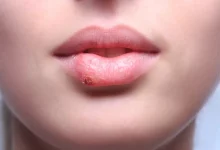 Bilim insanları, uçuklara neden olan herpes virüsünü genetik olarak değiştirerek ileri evre deri kanseriyle savaşta etkili bir tedaviye dönüştürdü.