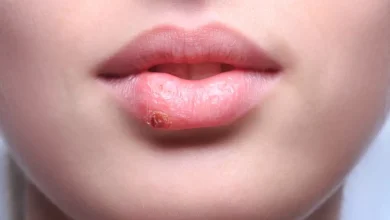 Bilim insanları, uçuklara neden olan herpes virüsünü genetik olarak değiştirerek ileri evre deri kanseriyle savaşta etkili bir tedaviye dönüştürdü.