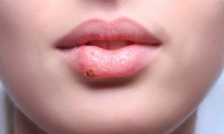 Bilim insanları, uçuklara neden olan herpes virüsünü genetik olarak değiştirerek ileri evre deri kanseriyle savaşta etkili bir tedaviye dönüştürdü.
