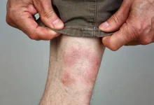 Kene ısırığıyla bulaşan Lyme hastalığı, genellikle ateş, yorgunluk ve eklem ağrılarıyla bilinse de depresyon, kaygı ve halüsinasyonlar gibi psikiyatrik belirtilere de yol açabiliyor.