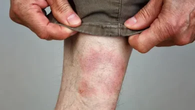 Kene ısırığıyla bulaşan Lyme hastalığı, genellikle ateş, yorgunluk ve eklem ağrılarıyla bilinse de depresyon, kaygı ve halüsinasyonlar gibi psikiyatrik belirtilere de yol açabiliyor.