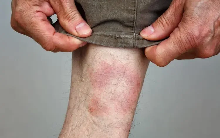 Lyme hastalığı sadece eklemleri değil zihni de etkiliyor 1 Kene ısırığıyla bulaşan Lyme hastalığı, genellikle ateş, yorgunluk ve eklem ağrılarıyla bilinse de depresyon, kaygı ve halüsinasyonlar gibi psikiyatrik belirtilere de yol açabiliyor.