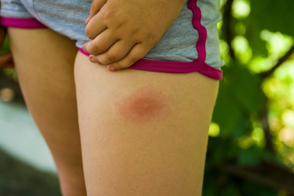 lyme hastaligi